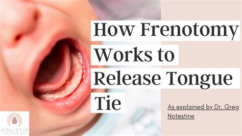 How Frenotomy Works to Release Tongue Tie - YouTube