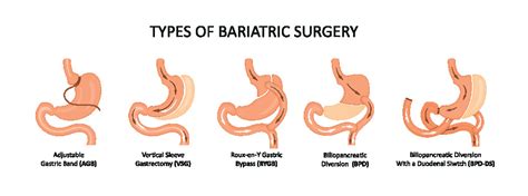 Bariatric surgery - The Johns Hopkins Patient Guide to Diabetes