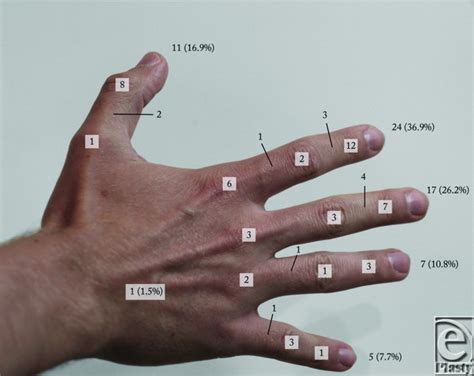 Ganglion Cyst Extensor Tendon