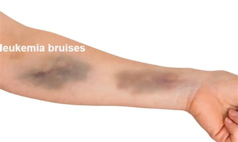 Are Bruises A Sign Of Leukemia? What do leukemia bruises look like? - Body Pain Tips