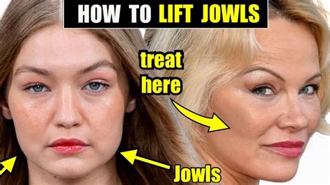 How to Lift & Tighten the Jowls with Sculptra-FDA Proven to Tighten Skin & Improve Jawline ...