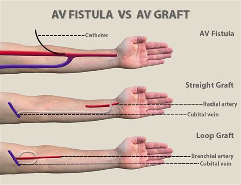 Difference Between Fistula and Graft - Differences Finder