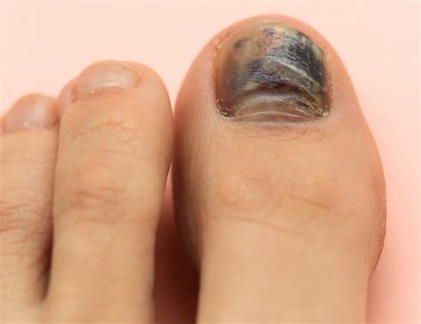 Topical Toenail Fungus Treatment While Pregnant - Nail Ftempo