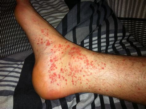 What Causes Red Spotty Rash - vrogue.co