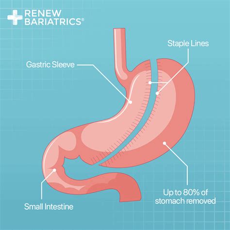 Mexico Bariatric Procedures & Options | Renew Bariatrics