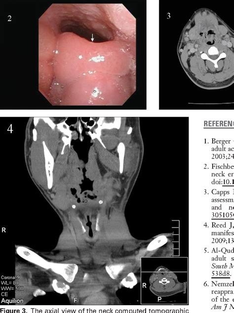 Figure 3 from Acute epiglottitis complicating an emphysematous abscess. - Semantic Scholar