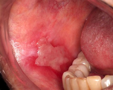 Mucous Membrane Pemphigoid Histology