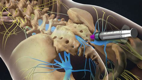 Interventional Pain Center Services - SASpine Surgical Associates in Spine