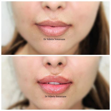 lip fillers near me prices - Virgie Bright