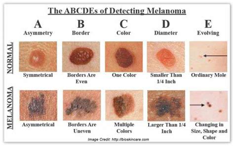 Melanoma Skin Cancer Stages