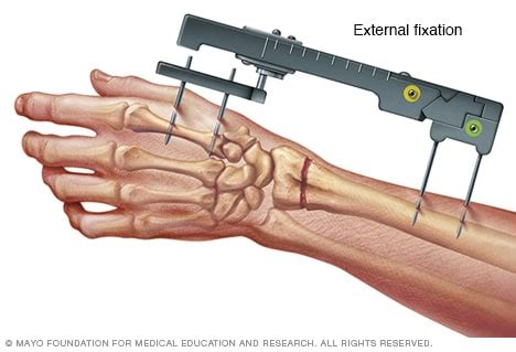 Broken wrist - Diagnosis and treatment - Mayo Clinic