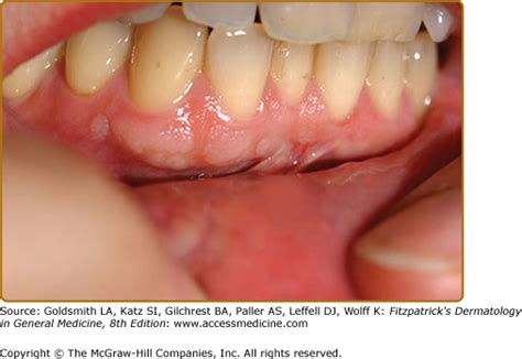 Tuberous Sclerosis Complex | Plastic Surgery Key