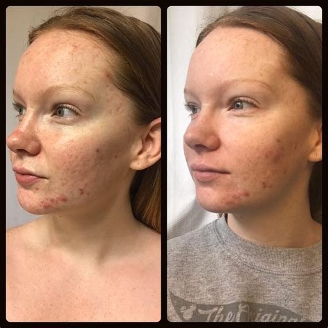 [B&A] - One week on Differin Gel