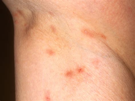 Rashes That Look Like Scabies: Causes, Symptoms, And Treatment | atelier-yuwa.ciao.jp