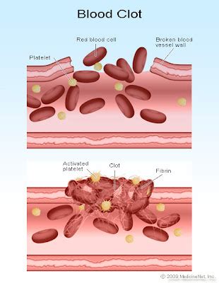 Blood Clots - Complication, Information - Ain Health