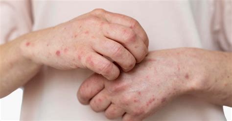 Post Inflammatory Erythema: Understanding Causes, Symptoms, Definitions, and Treatments