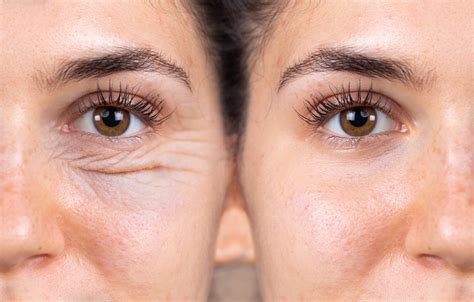 Blepharoplasty - DermWellesley