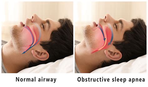 Sleep Apnea Facial Structure at David Buckley blog