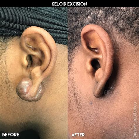 Miami Keloid Removal & Treatment | Arviv Medical Aesthetics