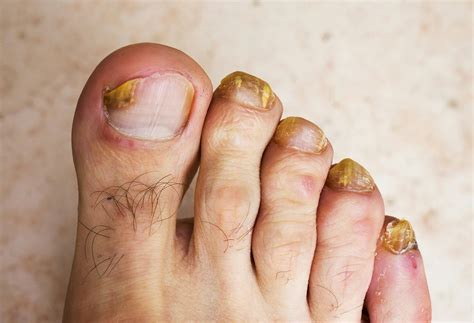 Nurses Know that Home Remedies Knock Out Nasty Nail Fungus | The People's Pharmacy