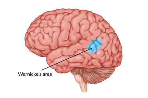 Damage to Wernicke's Area: Symptoms & Stages of Recovery