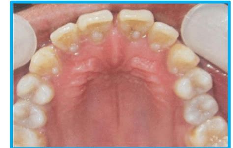 Clinical picture showing talon cusp on palatal aspect of all permanent ...