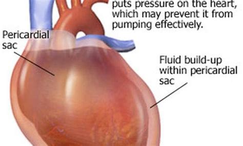 cardiac-tamponade – Liberal Dictionary