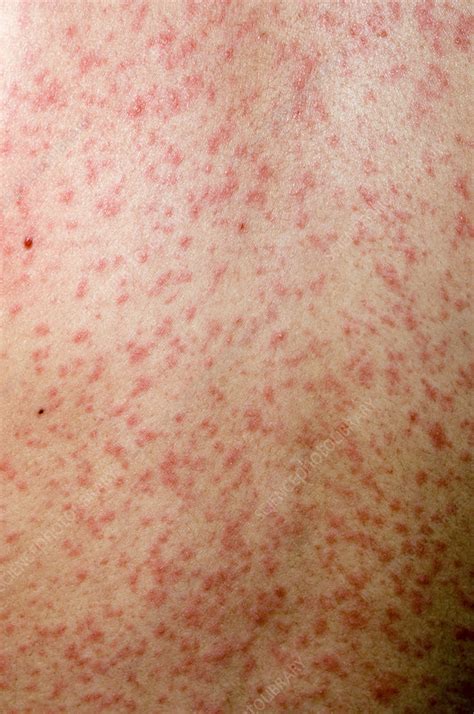 Measles rash - Stock Image - M210/0361 - Science Photo Library