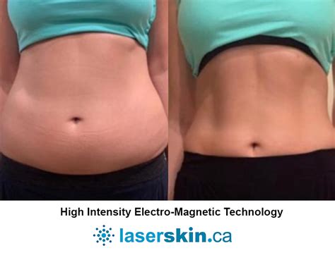 Body Contouring Before and After | LASERSKIN.CA Toronto