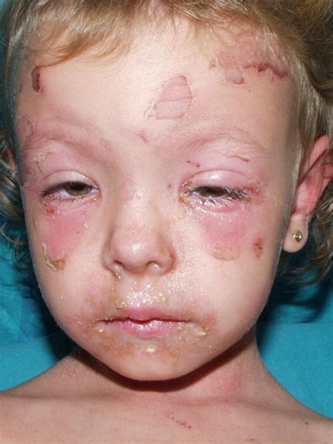 Staphylococcal scalded skin syndrome