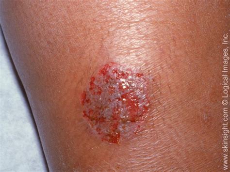 Discoid Eczema On Legs