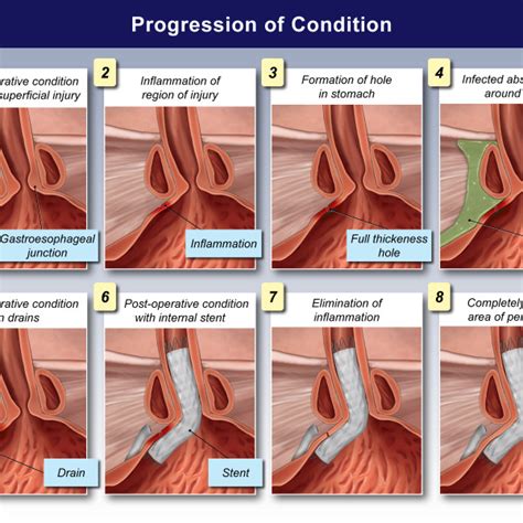 Subperiosteal Abscess on the Volar Radius - Trial Exhibits Inc.