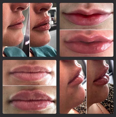 Restylane Versus Juvederm For Lips | Lipstutorial.org