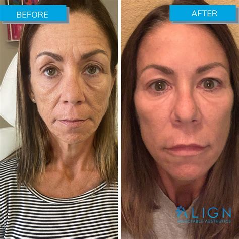 Before and After Xeomin® Injections | Align Injectable Aesthetics