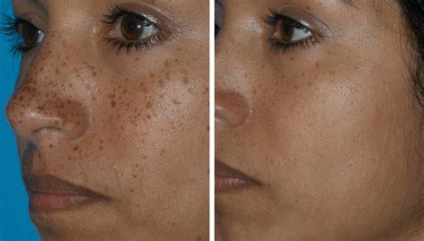 laser skin resurfacing before and after