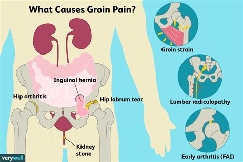 Groin Pain: Causes, Treatment, and When to See a Doctor