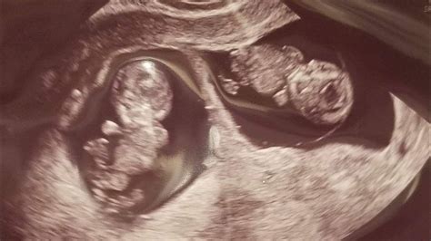 Early Twin Pregnancy Ultrasound