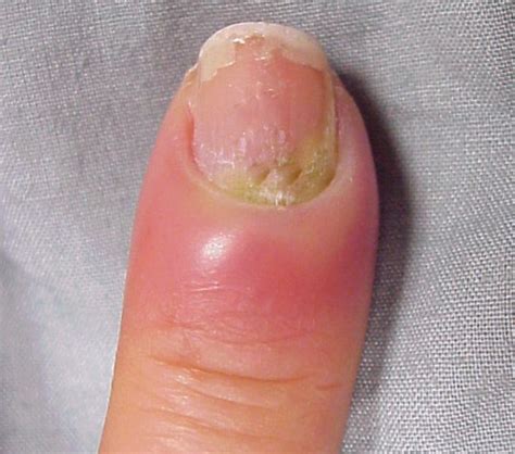 Hangnail Infection | Good Health