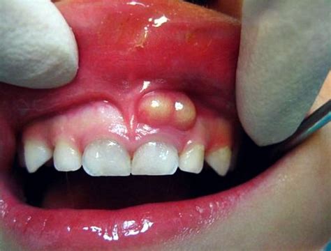 How Can You Cope with a Tooth Abscess?