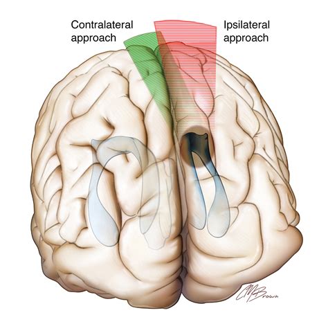 Interhemispheric Craniotomy | The Neurosurgical Atlas