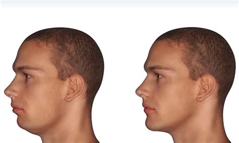 Chin Augmentation | Park Avenue Oral & Facial Surgery