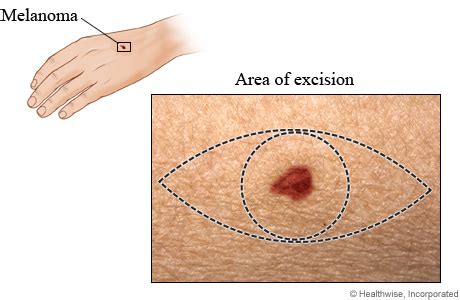 Melanoma Excision Surgery | HealthLink BC