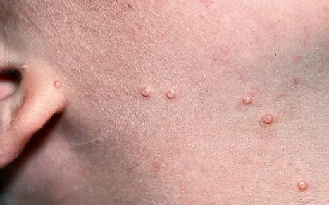 Molluscum Contagiosum Stages with Pictures