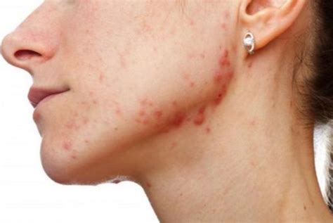 How to get rid of pimple scabs overnight? Here we have listed the best 36 home remedies for acne ...