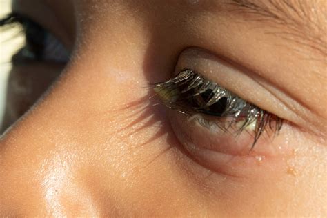 Remarkable Blepharitis Symptoms - Why Are Your Eyelid Irritated?