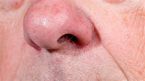 Nose Hair Benefits: Why You Should Not Remove It | OnlyMyHealth