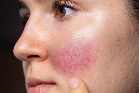 Find The Best Rosacea Treatment Plans Here!