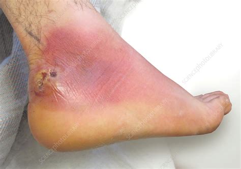 Foot Abscess - Stock Image - C009/4809 - Science Photo Library