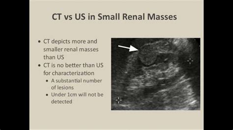 Renal Ultrasound parenchymal masses - YouTube