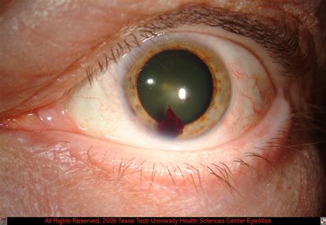 Blood In Cornea Of Eye